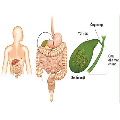 Bệnh sỏi mật
