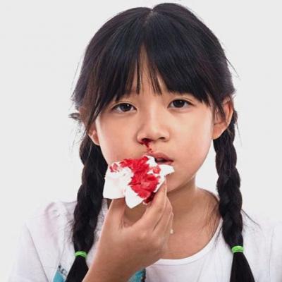 Chảy máu mũi