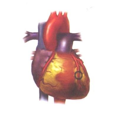 Xơ vữa động mạch